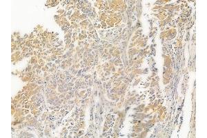 ABIN6263107 and ABIN6267016 at 1/100 staining human lung squamous cell carcinoma by IHC-P.