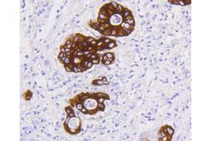 Paraformaldehyde-fixed, paraffin embedded Human stomach carcinoma tissue, Antigen retrieval by boiling in sodium citrate buffer (pH6) for 15min, Block endogenous peroxidase by 3% hydrogen peroxide for 30 minutes, Blocking buffer at 37°C for 20min, Antibody incubation with Cytokeratin 19 (2F3) Monoclonal Antibody  at 1:50 overnight at 4°C, followed by a conjugated secondary and DAB staining. (Cytokeratin 19 抗体)