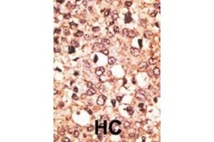 Formalin-fixed and paraffin-embedded human cancer tissue reacted with the primary antibody, which was peroxidase-conjugated to the secondary antibody, followed by AEC staining. (CRY1 抗体  (C-Term))