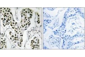 Immunohistochemistry analysis of paraffin-embedded human breast carcinoma tissue, using ZC3H4 Antibody. (ZC3H4 抗体  (AA 771-820))