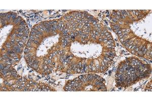 Immunohistochemistry of paraffin-embedded Human colon cancer tissue using PDGFC Polyclonal Antibody at dilution 1:40 (PDGFC 抗体)
