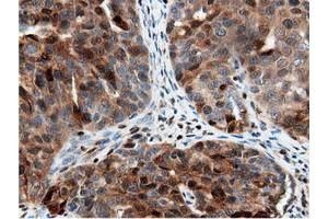 Immunohistochemical staining of paraffin-embedded Adenocarcinoma of Human colon tissue using anti-NT5DC1 mouse monoclonal antibody. (NT5DC1 抗体)