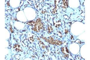 Formalin-fixed, paraffin-embedded human Angiosarcoma stained with Glycophorin A Mouse Monoclonal Antibody (GYPA/280). (CD235a/GYPA 抗体)