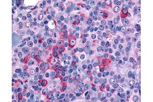 Anti-NANP antibody IHC of human Breast, Carcinoma. (NANP 抗体  (N-Term))