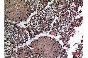 Immunohistochemistry (IHC) analysis of paraffin-embedded Human Lung Cancer, antibody was diluted at 1:100.