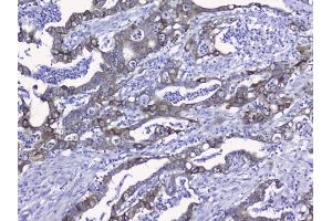 IHC analysis of Cytokeratin 19 using anti-Cytokeratin 19 antibody (ABIN3043288). (Cytokeratin 19 抗体  (C-Term))