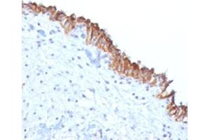 IHC testing of FFPE human bladder carcinoma with MAML2 antibody (clone MMLP2-1). (MAML2 抗体)