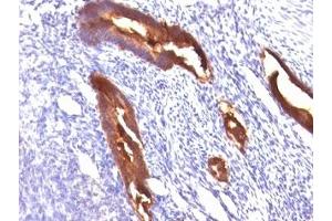Formalin-fixed, paraffin-embedded human endometrial carcinoma stained with EMA antibody (MUC1/845). (MUC1 抗体)