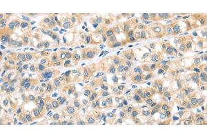 Immunohistochemistry of paraffin-embedded Human esophagus cancer tissue using RIPK4 Polyclonal Antibody at dilution 1:40 (RIPK4 抗体)