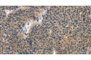 Immunohistochemistry of paraffin-embedded Human liver cancer tissue using COL4A2 Polyclonal Antibody at dilution 1:70 (COL4a2 抗体)