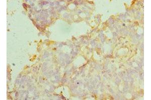 Immunohistochemistry of paraffin-embedded human endometrial cancer using ABIN7159417 at dilution of 1:100 (MANF 抗体  (AA 25-182))