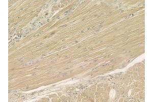 ABIN6260665 and ABIN6277012 at 1/100 staining human tongue carcinoma by IHC-P. (CDA 抗体  (Internal Region))