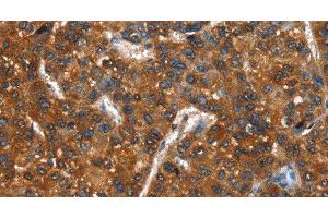 Immunohistochemistry of paraffin-embedded Human liver cancer using CTBP1 Polyclonal Antibody at dilution of 1:40 (CTBP1 抗体)