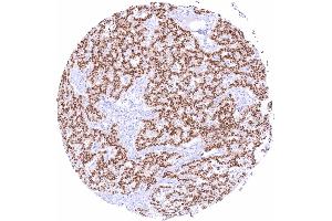 Pancreatic neuroendocrine tumor with strong predominantly nuclear Pax6 positivity of all tumor cells (PAX6 抗体)