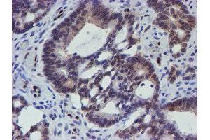 Immunohistochemical staining of paraffin-embedded Adenocarcinoma of Human colon tissue using anti-ELK3 mouse monoclonal antibody. (ELK3 抗体)