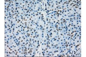 Immunohistochemical staining of paraffin-embedded Adenocarcinoma of colon tissue using anti-PRKYmouse monoclonal antibody. (PRKY 抗体)