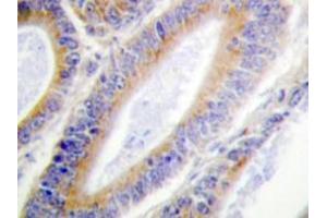 Immunohistochemistry analyzes of Casein Kinase I α antibody in paraffin-embedded human colon carcinoma tissue. (CSNK1A1 抗体)