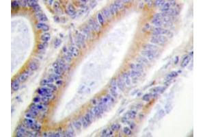 Immunohistochemistry analyzes of Casein Kinase I α antibody in paraffin-embedded human colon carcinoma tissue.