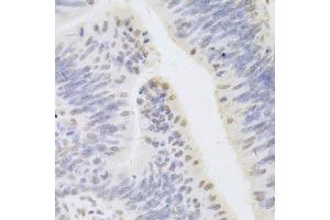 Immunohistochemistry of paraffin-embedded human rectal cancer using HDGF Antibody. (HDGF 抗体  (AA 1-240))