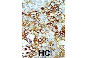 Formalin-fixed and paraffin-embedded human cancer tissue reacted with the primary antibody, which was peroxidase-conjugated to the secondary antibody, followed by AEC staining. (MAP4K2 抗体  (AA 288-319))