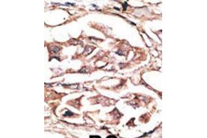 Formalin-fixed and paraffin-embedded human cancer tissue reacted with the primary antibody, which was peroxidase-conjugated to the secondary antibody, followed by AEC staining. (DKK2 抗体  (C-Term))