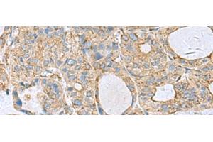 Immunohistochemistry of paraffin-embedded Human thyroid cancer tissue using CLTB Polyclonal Antibody at dilution of 1:70(x200) (CLTB 抗体)