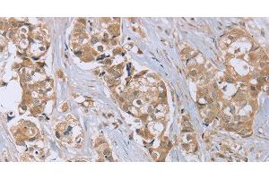 Immunohistochemistry of paraffin-embedded Human breast cancer tissue using RAB6C Polyclonal Antibody at dilution 1:45 (WTH3DI 抗体)