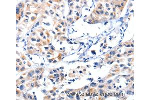 Immunohistochemistry of Human lung cancer using FBLN5 Polyclonal Antibody at dilution of 1:85