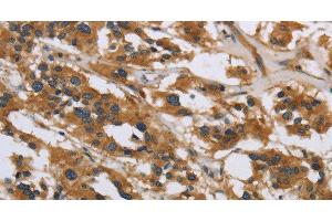 Immunohistochemistry of paraffin-embedded Human thyroid cancer using IL5RA Polyclonal Antibody at dilution of 1:40 (IL5RA 抗体)