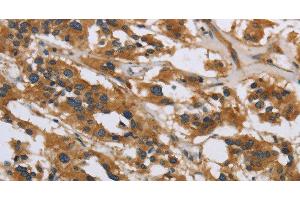 Immunohistochemistry of paraffin-embedded Human thyroid cancer using IL5RA Polyclonal Antibody at dilution of 1:40 (IL5RA 抗体)