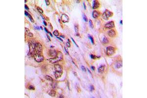 Immunohistochemical analysis of Aurora A staining in human lung cancer formalin fixed paraffin embedded tissue section. (Aurora A 抗体  (C-Term))