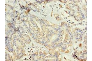 Immunohistochemistry of paraffin-embedded human breast cancer using ABIN7173703 at dilution of 1:100 (TUBG2 抗体  (AA 276-451))