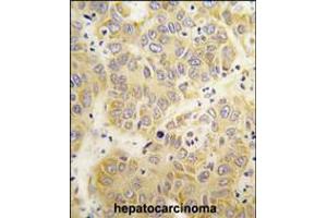 Formalin-fixed and paraffin-embedded human hepatocarcinoma tissue reacted with the VARS antibody , which was peroxidase-conjugated to the secondary antibody, followed by DAB staining. (VARS 抗体  (N-Term))