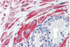 Human Prostate (formalin-fixed, paraffin-embedded) stained with SSX4 antibody ABIN462200 followed by biotinylated goat anti-rabbit IgG secondary antibody ABIN481713, alkaline phosphatase-streptavidin and chromogen.