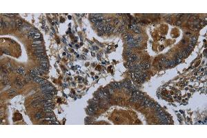 Immunohistochemistry of paraffin-embedded Human colon cancer using GLUL Polyclonal Antibody at dilution of 1:60 (GLUL 抗体)