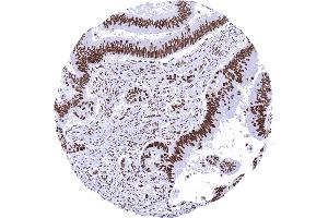 Colon Colorectal adenocarcinoma with strong MSH2 immunostaining in cancer cells and in stromal cells (Recombinant MSH2 抗体)