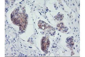 Immunohistochemical staining of paraffin-embedded Carcinoma of Human pancreas tissue using anti-MLF1 mouse monoclonal antibody. (MLF1 抗体)