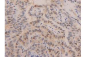 Detection of PCNA in Human Thyroid cancer Tissue using Polyclonal Antibody to Proliferating Cell Nuclear Antigen (PCNA) (PCNA 抗体  (AA 6-261))