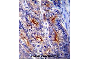 LGALS3 Antibody (C-term) (ABIN1536595 and ABIN2843799) immunohistochemistry analysis in formalin fixed and paraffin embedded human colon carcinoma followed by peroxidase conjμgation of the secondary antibody and DAB staining. (Galectin 3 抗体  (C-Term))