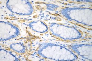 Immunohistochemistry was performed on paraffin-embedded human sigmoid colon carcinoma using caveolin 1 antibody (ABIN7797944), 1:200). (Recombinant Caveolin-1 抗体)