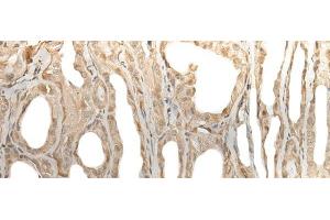Immunohistochemistry of paraffin-embedded Human thyroid cancer tissue using ZBTB18 Polyclonal Antibody at dilution of 1:50(x200) (ZNF238 抗体)
