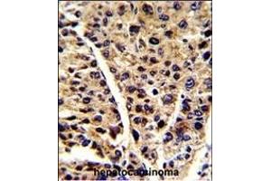 Formalin-fixed and paraffin-embedded human hepatocarcinoma reacted with ENOB Antibody (Center), which was peroxidase-conjugated to the secondary antibody, followed by DAB staining. (ENO3 抗体  (AA 237-264))
