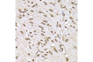 Immunohistochemistry of paraffin-embedded human colon carcinoma using LMNB2 Antibody (ABIN5973877) at dilution of 1/200 (40x lens). (Lamin B2 抗体)