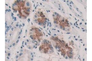 Detection of KARS in Human Stomach cancer Tissue using Polyclonal Antibody to Lysyl tRNA Synthetase (KARS) (KARS 抗体  (AA 323-553))