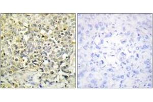 Immunohistochemistry analysis of paraffin-embedded human lung carcinoma tissue, using CDKL4 Antibody. (CDKL4 抗体  (AA 266-315))