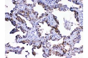 IHC testing of FFPE human lung cancer tissue with ASL antibody at 1ug/ml. (Adenylosuccinate Lyase 抗体)
