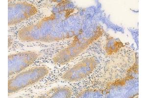 ABIN6259081 and ABIN6273900 at 1/100 staining human colon carcinoma by IHC-P. (Purinergic Receptor P2Y, G-Protein Coupled, 13 (P2RY13) (C-Term) 抗体)