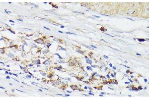 Immunohistochemistry of paraffin-embedded Human gastric cancer using TREM2 Polyclonal Antibody at dilution of 1:200 (40x lens). (TREM2 抗体)