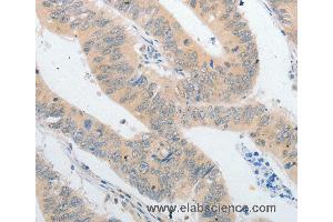 Immunohistochemistry of Human colon cancer using PPAP2A Polyclonal Antibody at dilution of 1:40 (PLPP1 抗体)