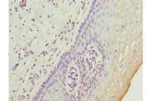 Immunohistochemistry of paraffin-embedded human cervical cancer using ABIN7174639 at dilution of 1:100 (UGT2B10 抗体  (AA 20-280))